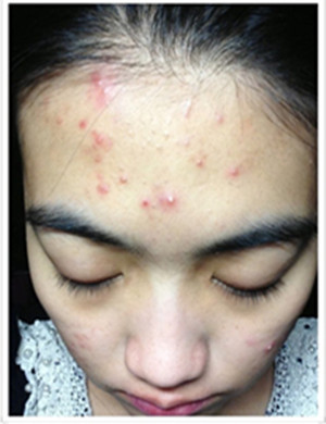 背后每年秋冬长痘怎么治,经常长痘的肤质怎样避免长痘