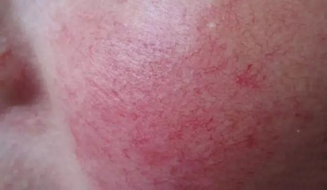 酒渣鼻怎么改善学生党,酒渣鼻严重怎么彻底治疗