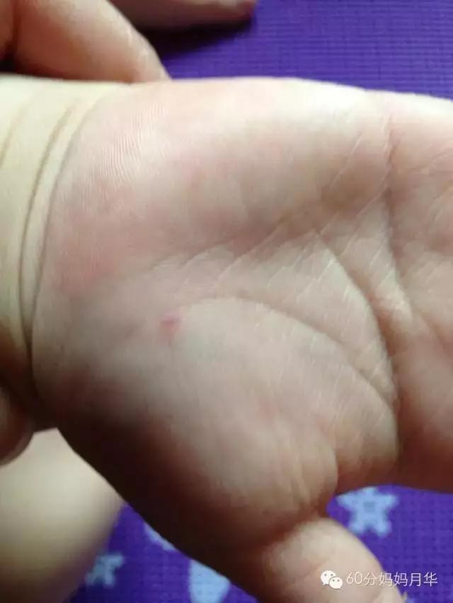 手足口病高发期勤洗手很重要,手足口病高发期宝宝如何预防