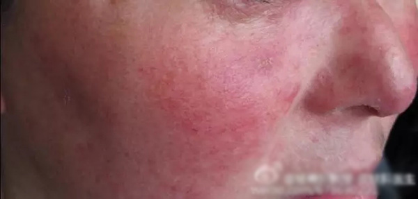 怎样分辨酒渣鼻,酒渣鼻严重怎么治疗