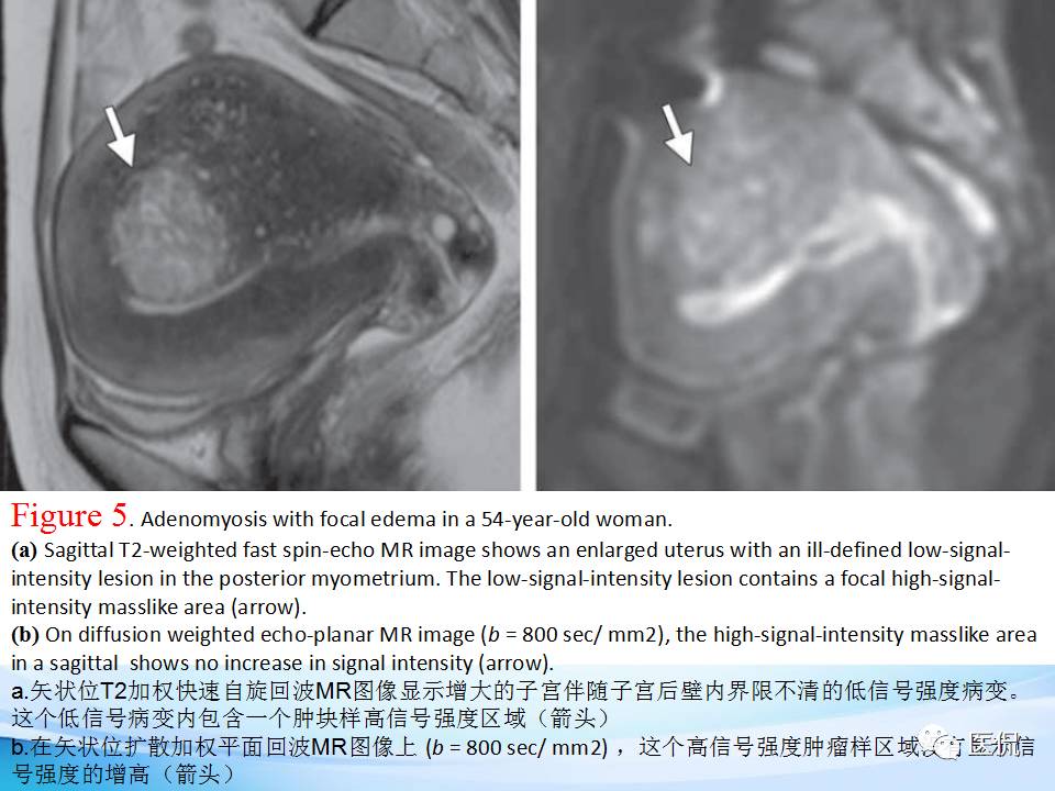 双语PPT：子宫腺肌症常见和不常见的MRI表现医学影像