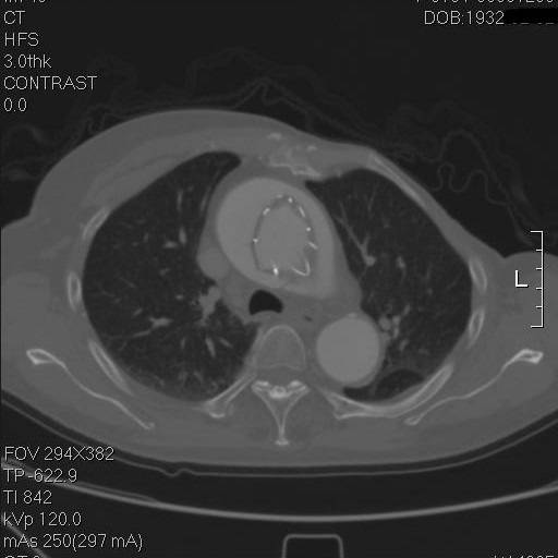 主动脉夹层袭来的恐慌,你不懂