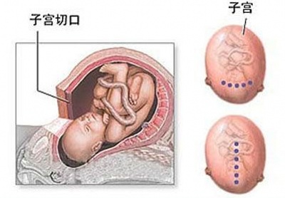 对于选择剖腹产的孕妈妈而言,到底剖腹产是怎样的?(图解)