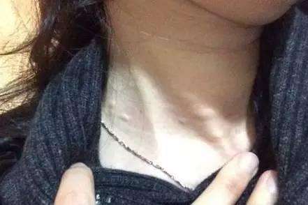 脖子上长了很多小颗粒怎么调理,脖子会出现各种症状及原因