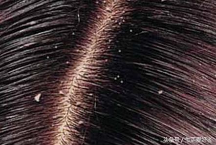 严重脱发怎么办最有效的方法,脱发怎么办最快最有效