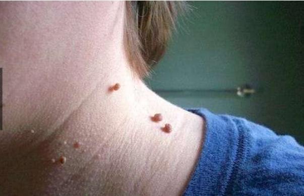 脖子发胀难受怎么回事怎么调理,脖子出现这三种特征可能已患大病