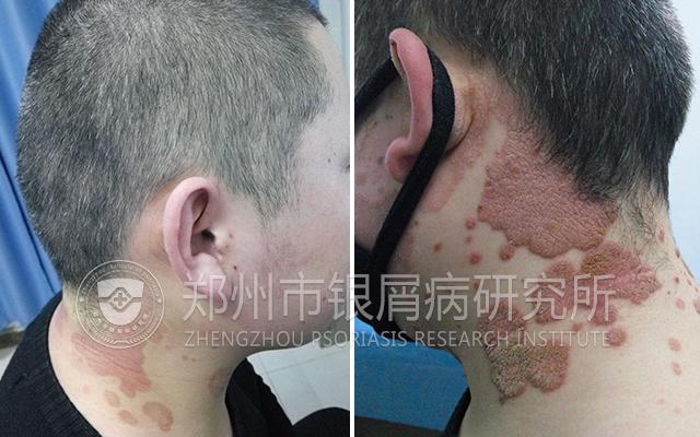 银屑病绝不能忌口,银屑病真的不能用激素么