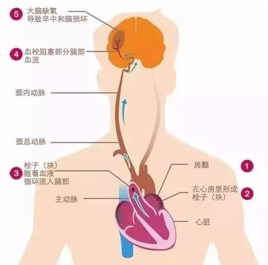 喝酒引起房颤戒酒后恢复吗,喝酒引起的房颤把酒戒了会好吗
