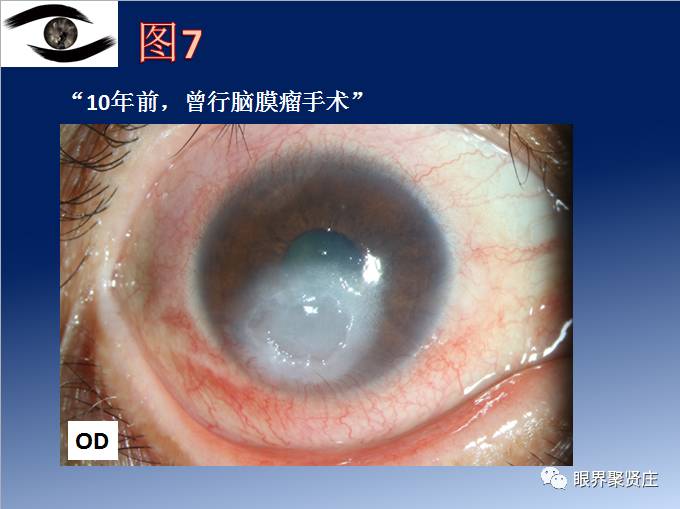 几种眼病的视野图,看图识病是什么病