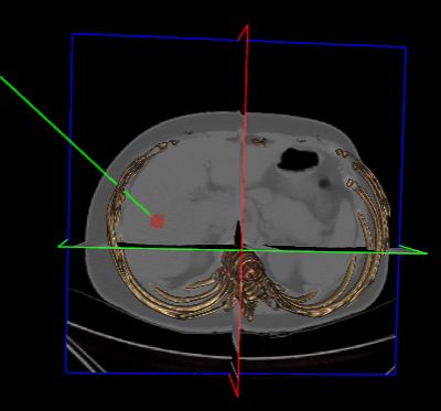 超声引导肝癌精准消融治疗,肝癌消融治疗现状问题及应用前景