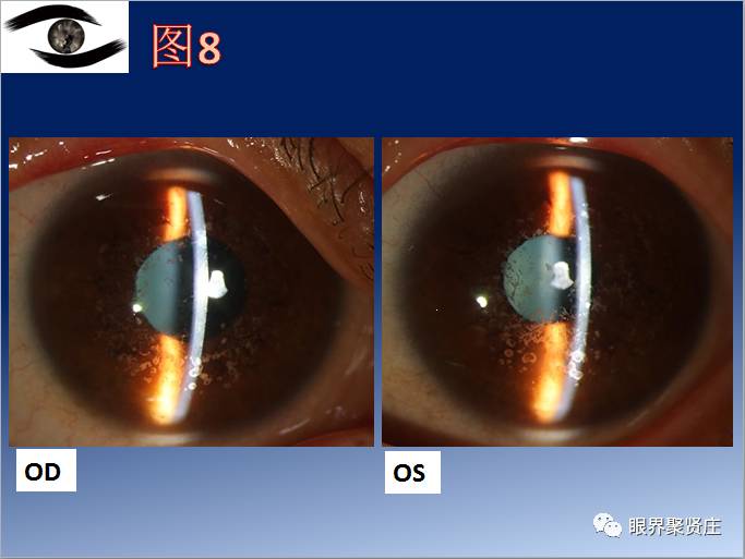 几种眼病的视野图,看图识病是什么病