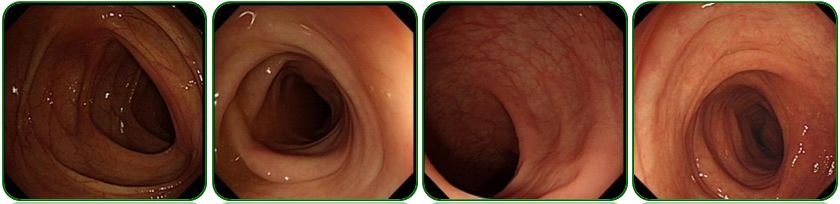 同为腹水，命运迥异