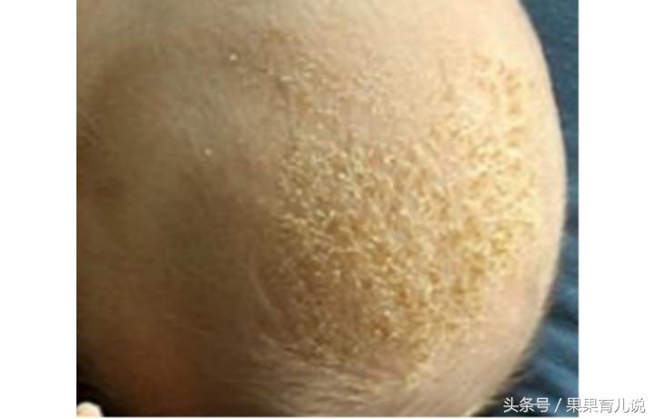 宝宝头上的头垢如何处理？