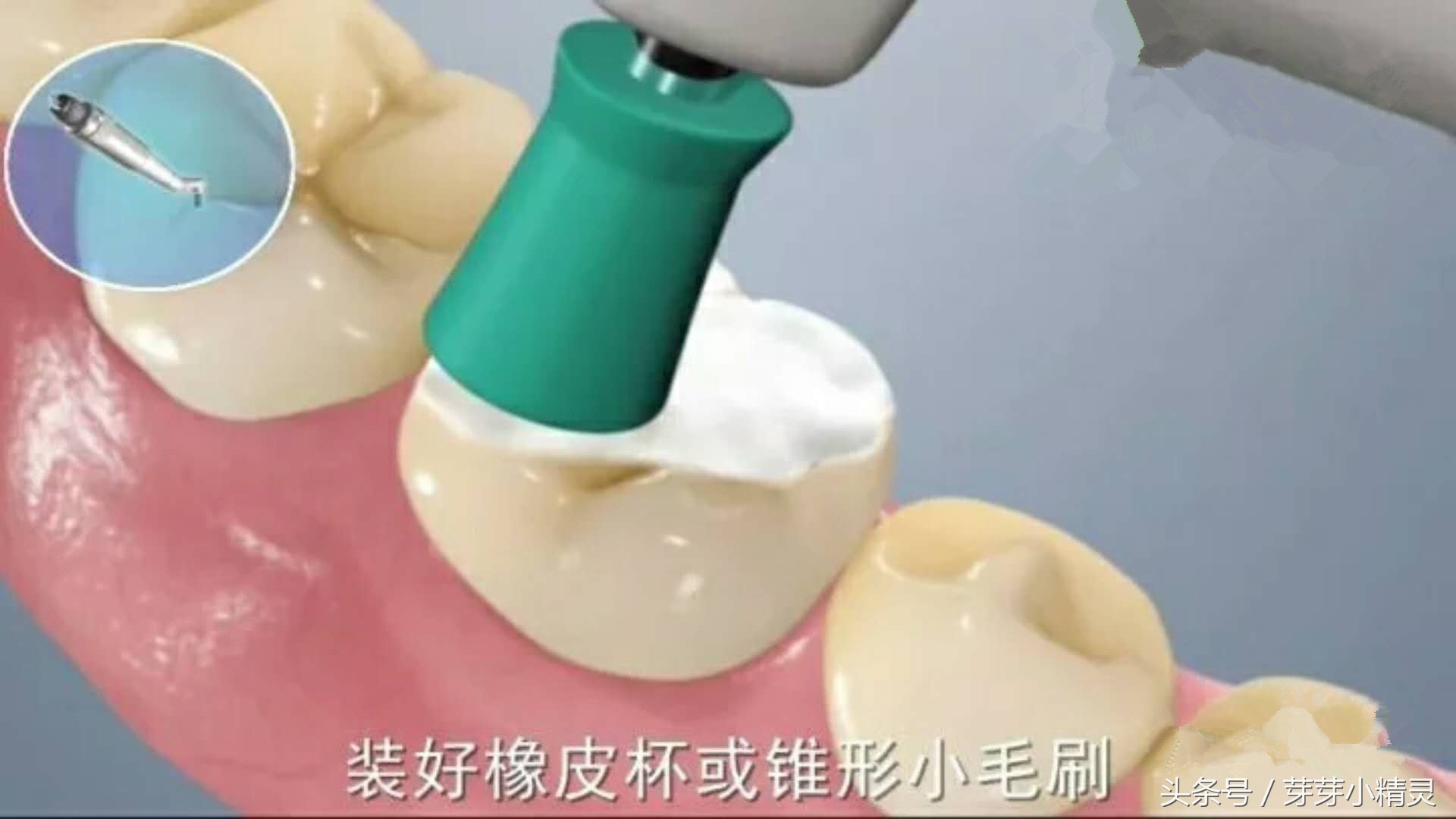 窝沟封闭注意事项,虫牙可以做窝沟封闭吗