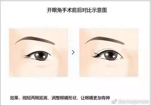 眼部整形常见的15个问题,眼部护理要避开九大误区