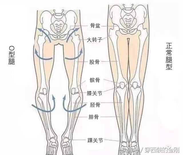 腿型问题怎么改善,o型腿怎样矫正不影响膝关节