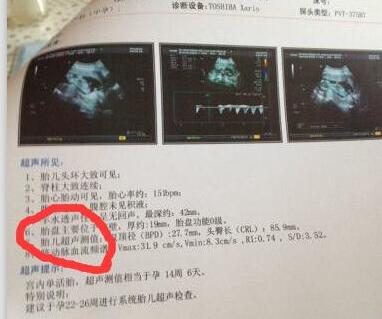 孕期B超单透露的重要信息!教你看懂9大关键指标