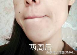 痘痘肌敏感肌混油皮区别,痘痘肌混油皮的面霜推荐