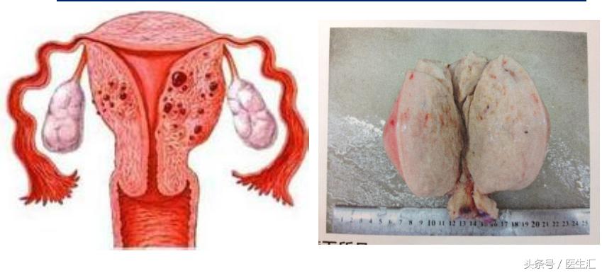 子宫腺肌症中医病历,子宫腺肌病疑难病例分析报告
