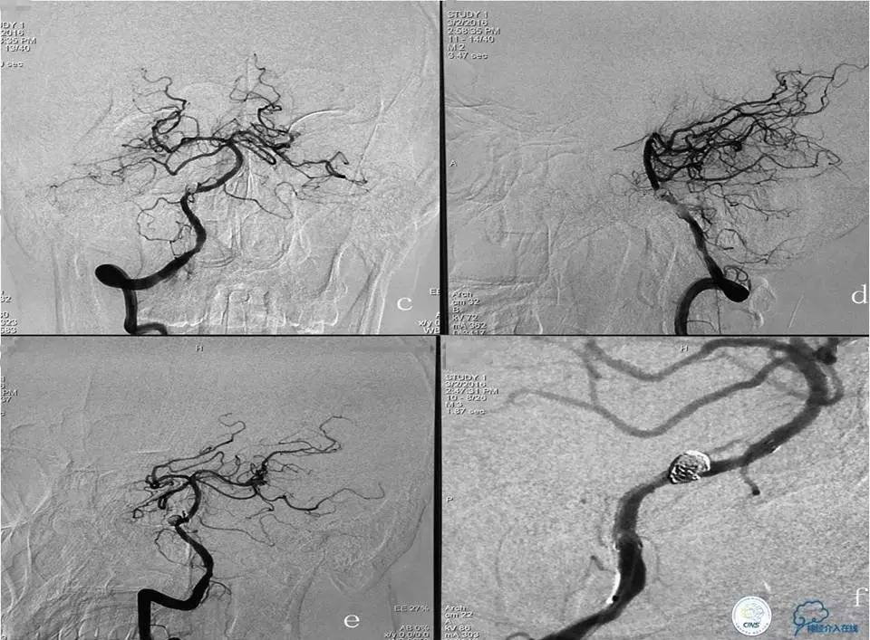 脑动脉瘤并颈动脉狭窄怎么治疗,脑动脉血管狭窄介入治疗效果好吗