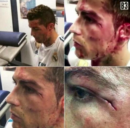 足球场上c罗受伤的暖心瞬间,足球超燃瞬间c罗受伤继续踢