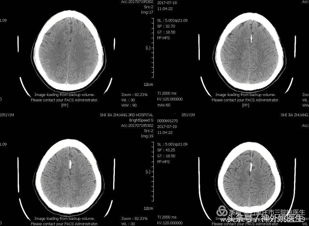 颈内动脉狭窄可以做内膜剥脱术吗,颈内动脉内膜剥脱手术指征