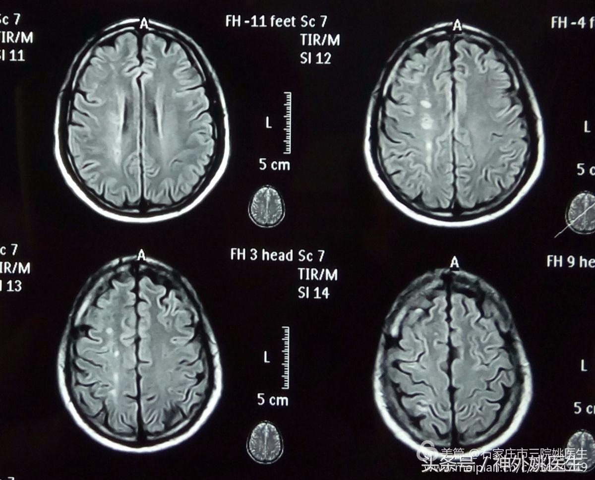 颈内动脉狭窄可以做内膜剥脱术吗,颈内动脉内膜剥脱手术指征