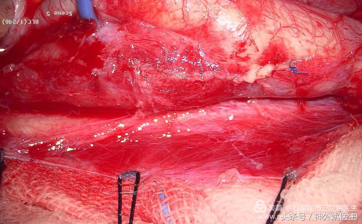 颈内动脉狭窄可以做内膜剥脱术吗,颈内动脉内膜剥脱手术指征