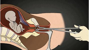 堕胎时人类是怎样一步步杀死自己孩子的?妈妈会看哭!