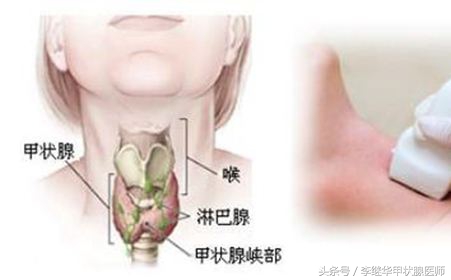 甲状腺疾病科学认识才能正确防治,感冒引起的甲状腺炎怎么治