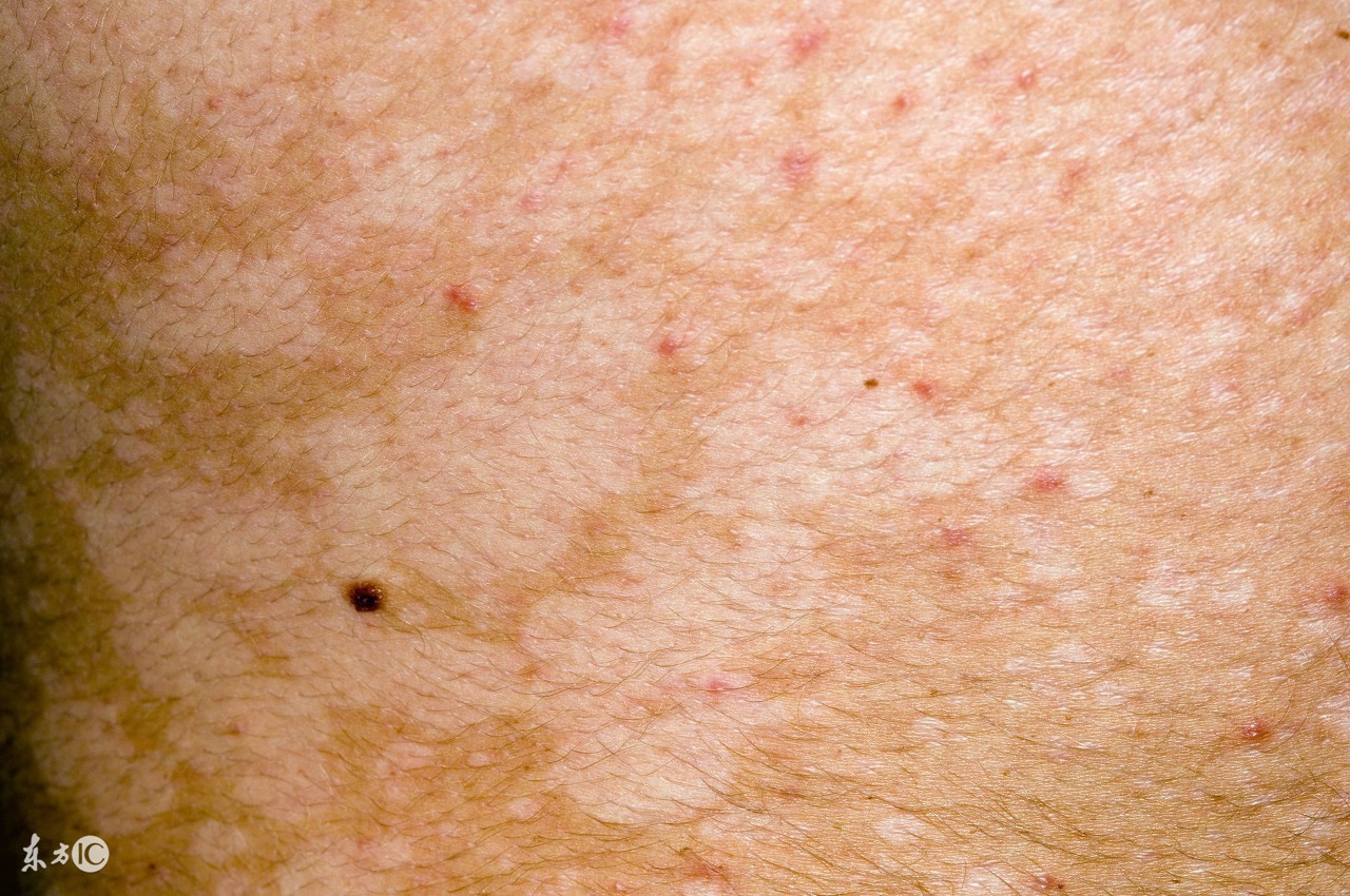 要治好花斑癣需要患者怎么做