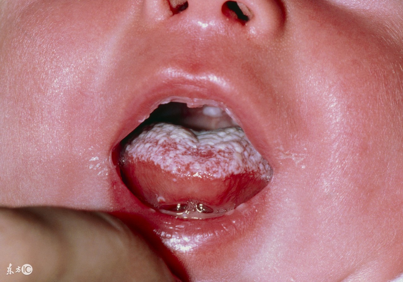 宝宝得了鹅口疮怎么快速治好,宝宝得了鹅口疮会自愈吗