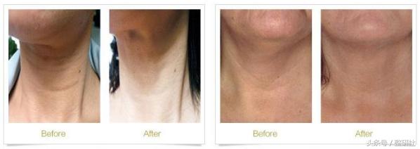 温顺谦和大妈修炼计——扼制颈部老化