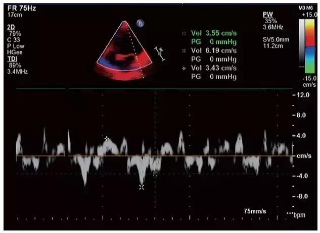 心脏扩大有什么症状和后果,心脏扩大症