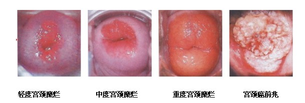 宫颈的问题，这方面可不能偷懒！