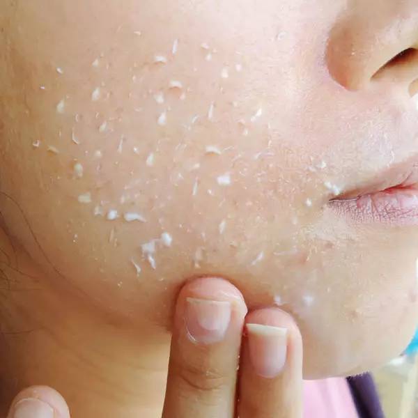 脸上突然冒出一堆大痘痘什么原因,脖子后面脸上都长了很多红色痘痘