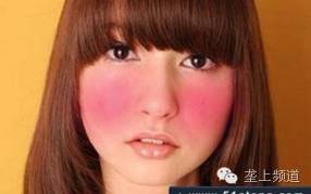 脸上长痘痘可以用醋洗脸吗,用醋洗面会长痘