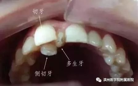 孩子牙缝很小需要干预吗,小朋友牙缝大可以干预吗