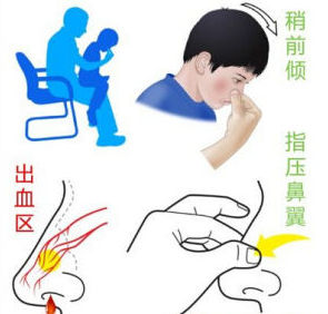 鼻子爱出血有什么偏方,鼻子流血怎么止血冷知识
