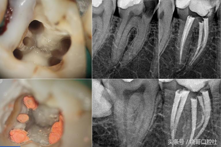 牙神经死掉牙齿发黑,五岁儿童牙神经坏死牙发黑怎么办