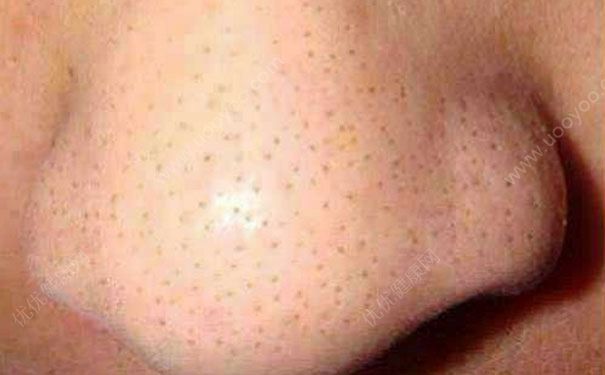 彻底去鼻子黑头的最好方法,青春期鼻子有黑头怎么彻底清除