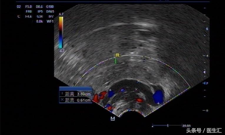 异位妊娠的病例分析题,异位妊娠的诊断要点及鉴别诊断