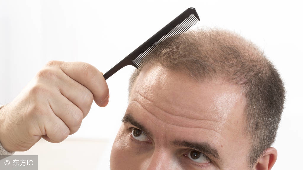 雄激素脱发用药,脱发的用药方案