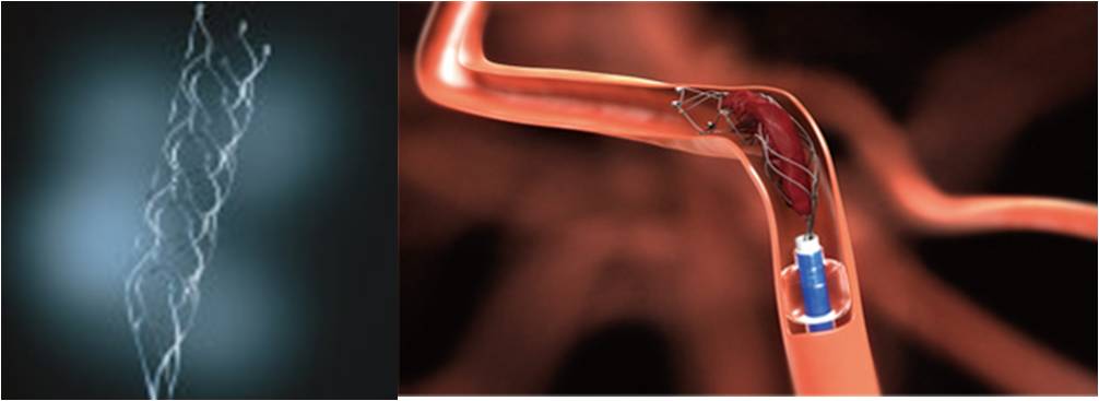 取栓慢性闭塞如何避免血栓逃逸,急性大脑中动脉栓塞取栓时间