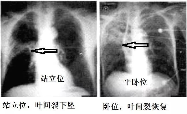 如何通过肺ct看出自己得了肺炎,肺ct怎么看出是病毒还是细菌