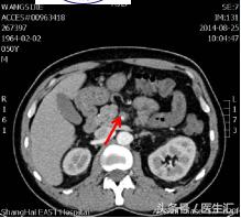 呕吐吐出咖啡色液体怎么回事,呕吐出黄色液体后怎么处理