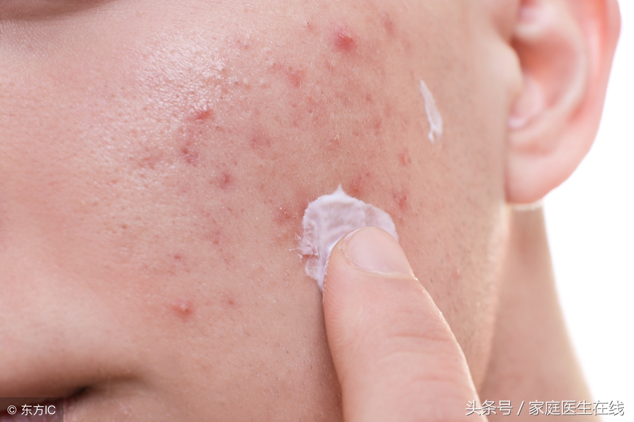 自制敏感肌肤祛痘美白嫩肤面膜,自制中药祛痘面膜