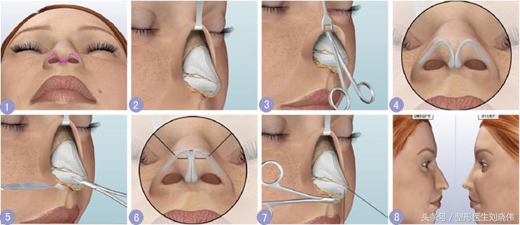 小鼻综合和大鼻综合的区别,鼻整形科普