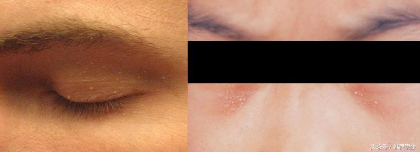 眼睛周围长脂肪粒该怎么洗脸,眼睛周围长脂肪粒是什么原因