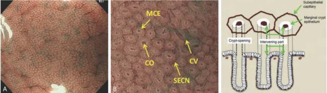 内镜检查痛苦吗,内镜检查是怎么做的